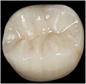 dental crown